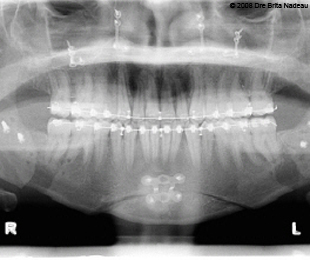 Marie-Hélène Cyr - Radiographie panoramique après les chirurgies orthognatiques (22 avril 2008)